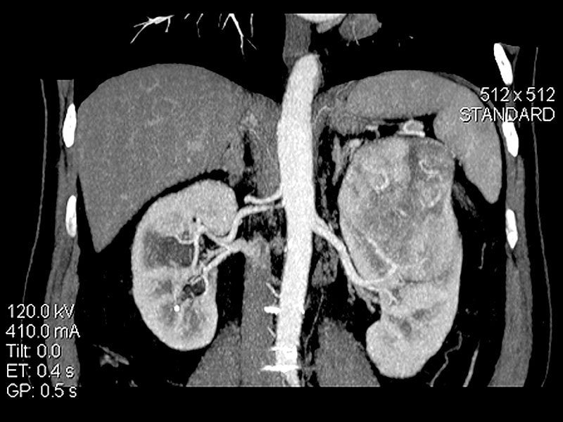Кт картина са левой почки