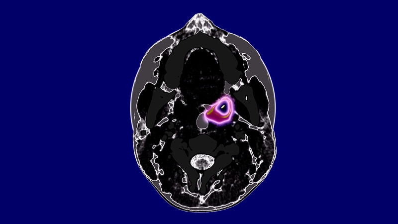 icd 10 code for history of cancer tonsil