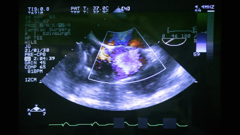 early-avr-in-asymptomatic-severe-aortic-stenosis-new-support