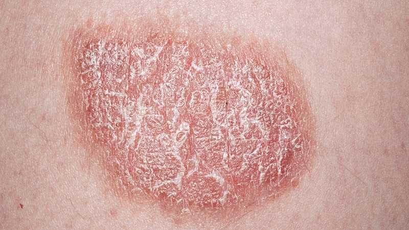 fast-five-quiz-psoriasis-types