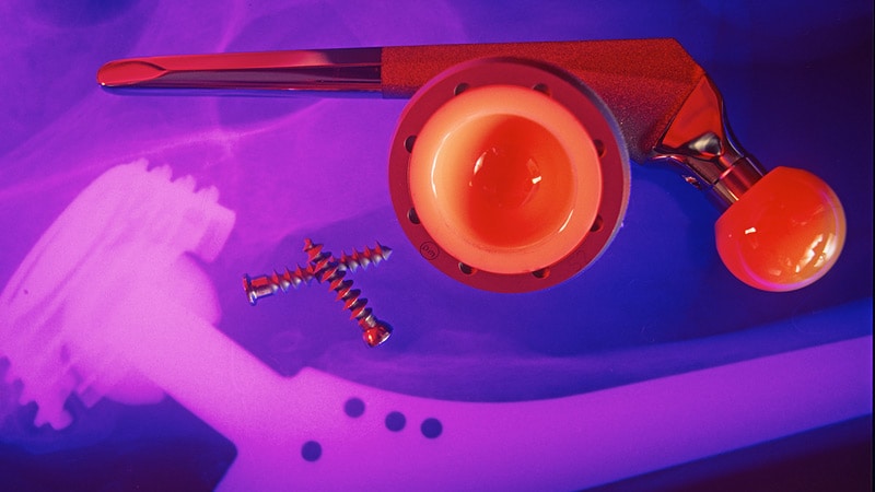 Will 3D Printing Revolutionize Orthopedic Implant Surgery?
