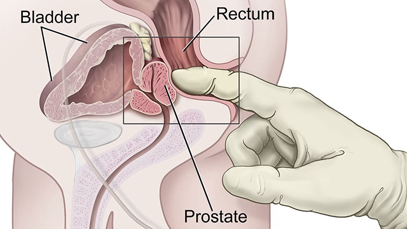 boggy prostate on dre Szép prosztatitis