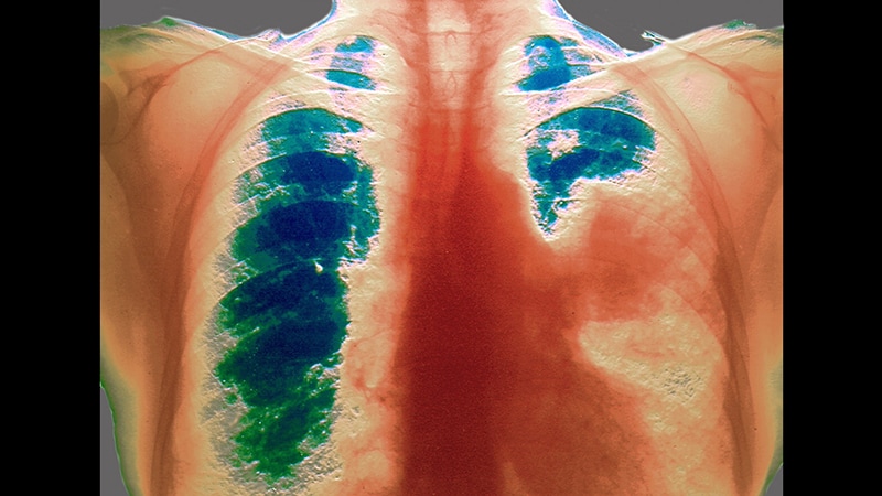 Global Lung Cancer Statistics 2021