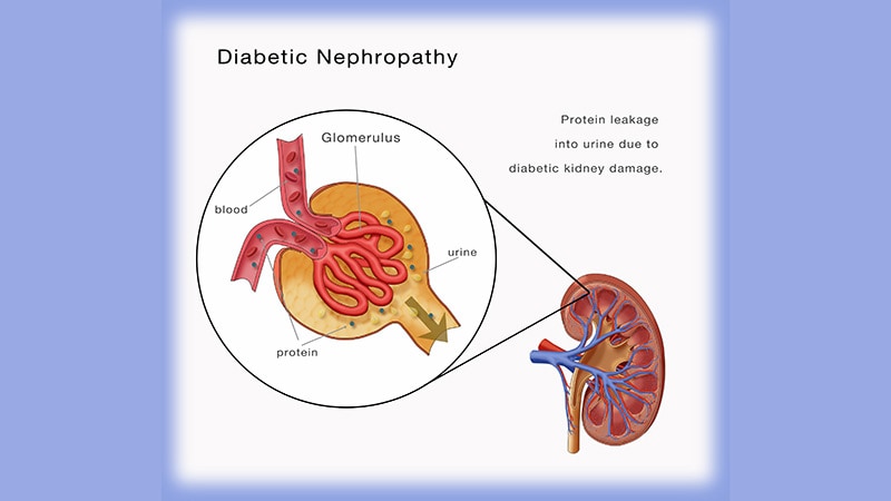 Fast Five Quiz: Diabetic Nephropathy Management