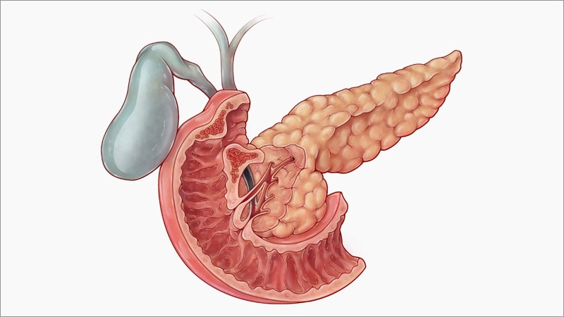 Type 2 Diabetes Remission Can Restore Pancreas Morphology