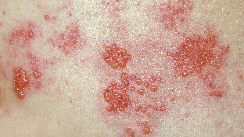 can herpes cause shingles