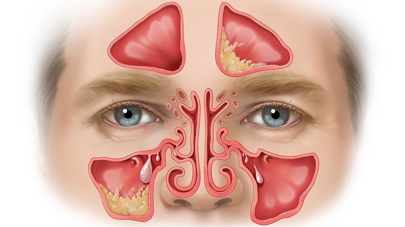 Nasal Polyps X Ray