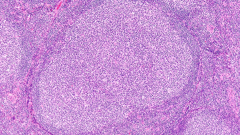 Le zanubrutinib-obinutuzumab double la SSP dans le lymphome ...