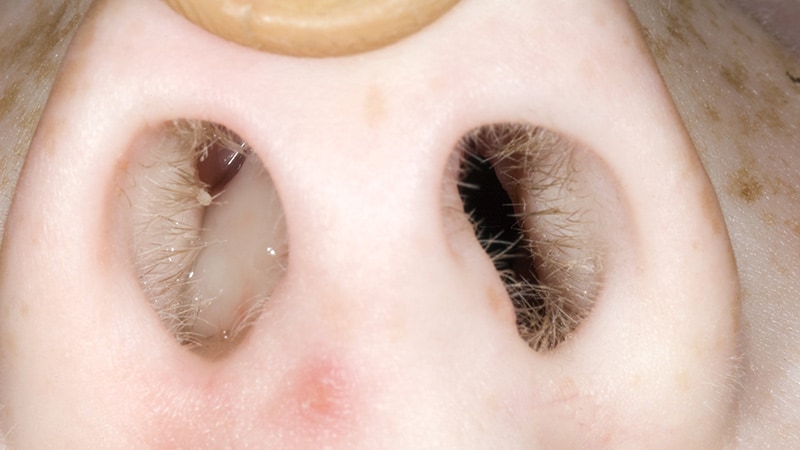 Fast Five Quiz: Pediatric Nasal Polyps - Page 4
