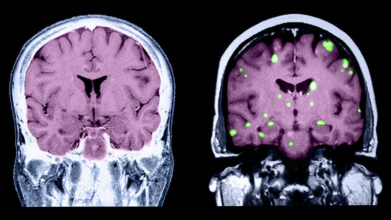 Key Strategies For Managing Breast Cancer Brain Metastases