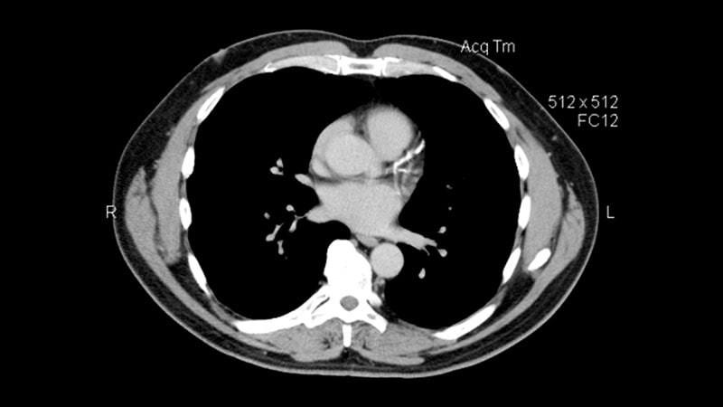 Physical Activity Paradoxically Tied to Higher Coronary Calcium