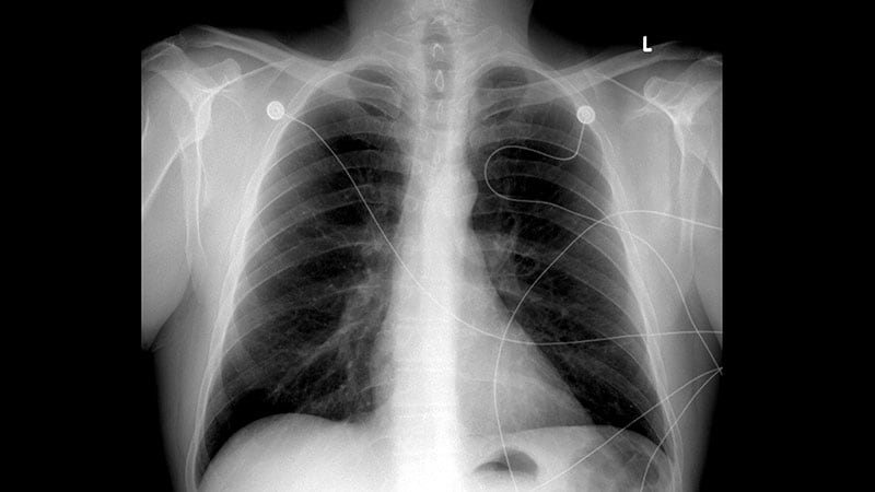 A smoker with chest pain after eating