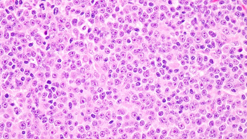 Fast Five Quiz: Progression of Follicular Lymphoma