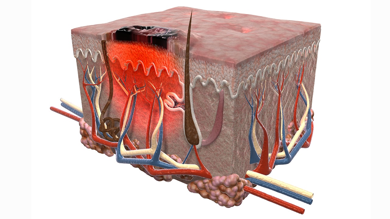 Fast Five Quiz: Metastatic Melanoma