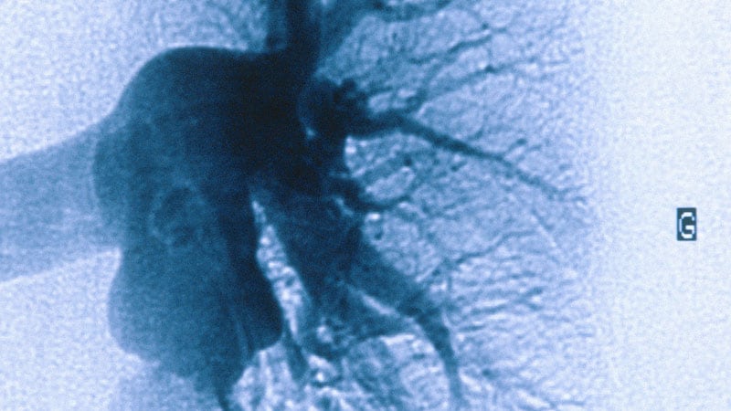 Fast Five Quiz: PAH Presentation and Diagnosis