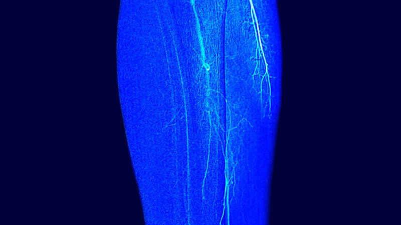 Fast Five Quiz: PAOD Signs and Symptoms