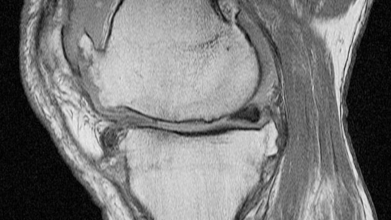 Fast Five Quiz: Intra-articular Injections for Knee OA