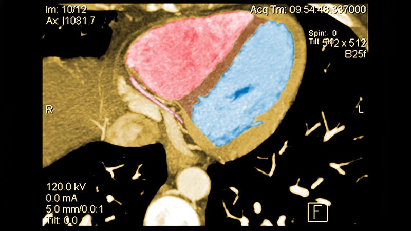 Subclinical CAD by CT, Stenoses or Not, Predicts MI Risk