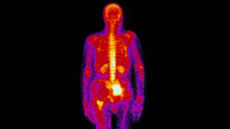 fast-five-quiz-management-of-anaplastic-thyroid-carcinoma