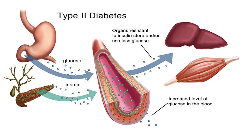 First-Line Therapy in T2D: Has Metformin Been 'Dethroned'?