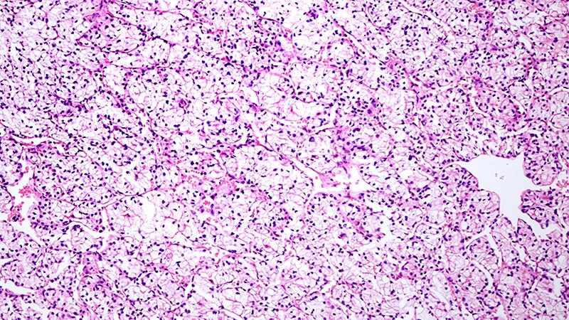 Fact or Fiction: Clear Cell Renal Cell Carcinoma - Page 5