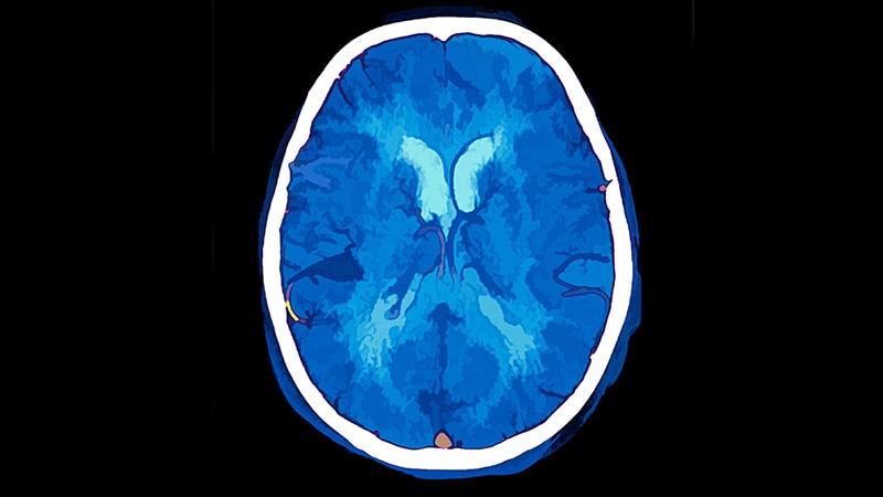 Positional Headaches in a Patient With Acne