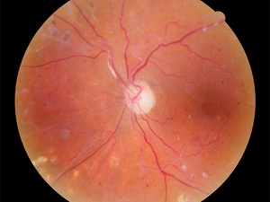 Anti-VEGF Treatment May Not Stop Diabetic Retinopathy