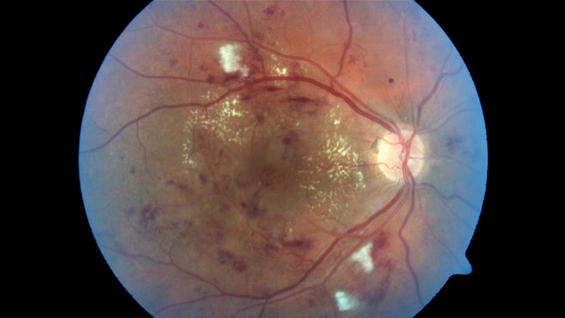 Macular Edema - Patients - The American Society of Retina Specialists