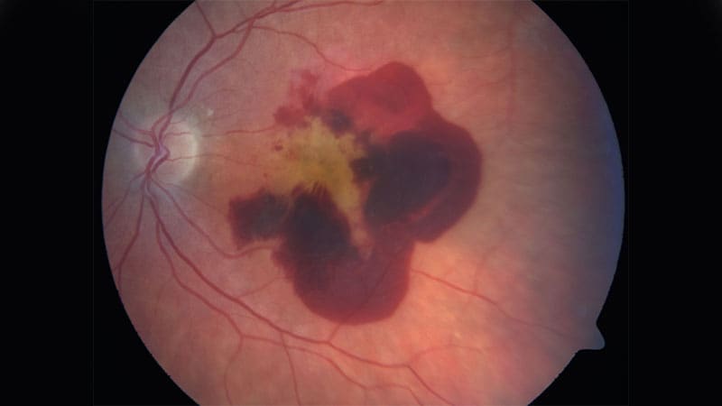 Uncontrolled Wet AMD: Drug Switch Can Mute Disease Activity