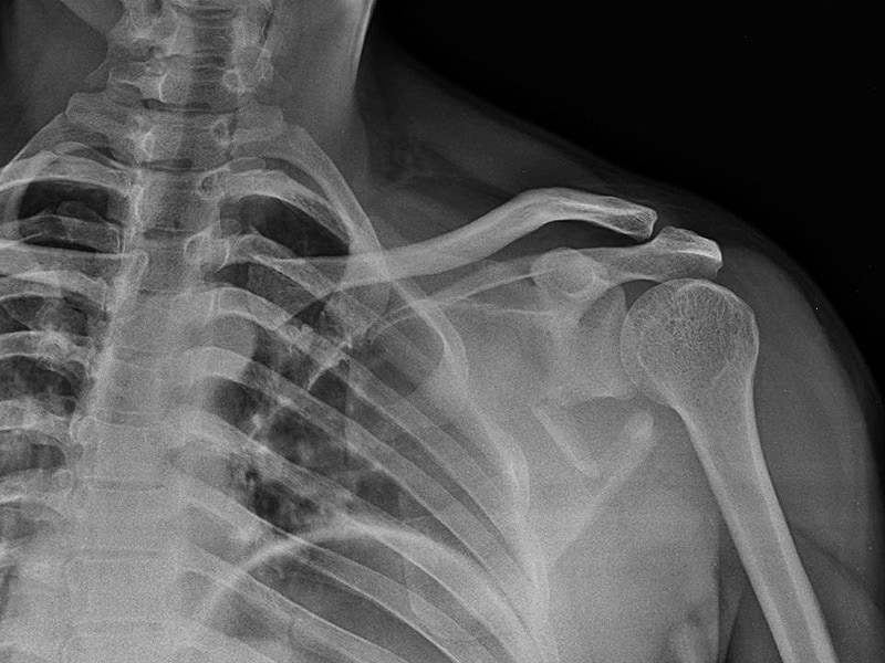 Scapular Fractures: Diagnosis and Treatment Plan