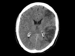 MR CLEAN at 2 Years: Sustained Endovascular Benefit in Stroke 