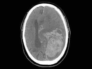 Neurologist Experience Affects Stroke Thrombolysis Outcome