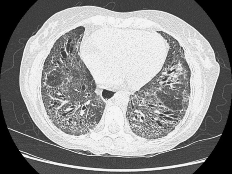 cellcept lung disorder