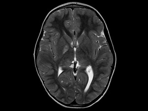 White Matter Lesions Linked to Rising Plasma Glucose