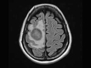 Major Trial: Forgo Whole-Brain RT in Lung Cancer