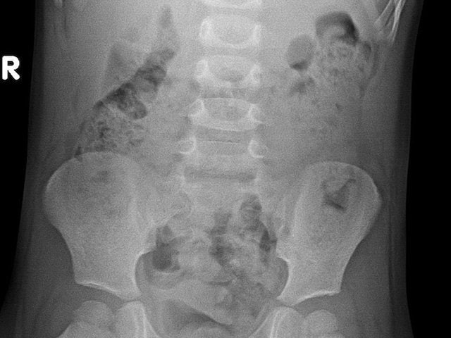 Abdominal X-rays Decreased in Children With Constipation