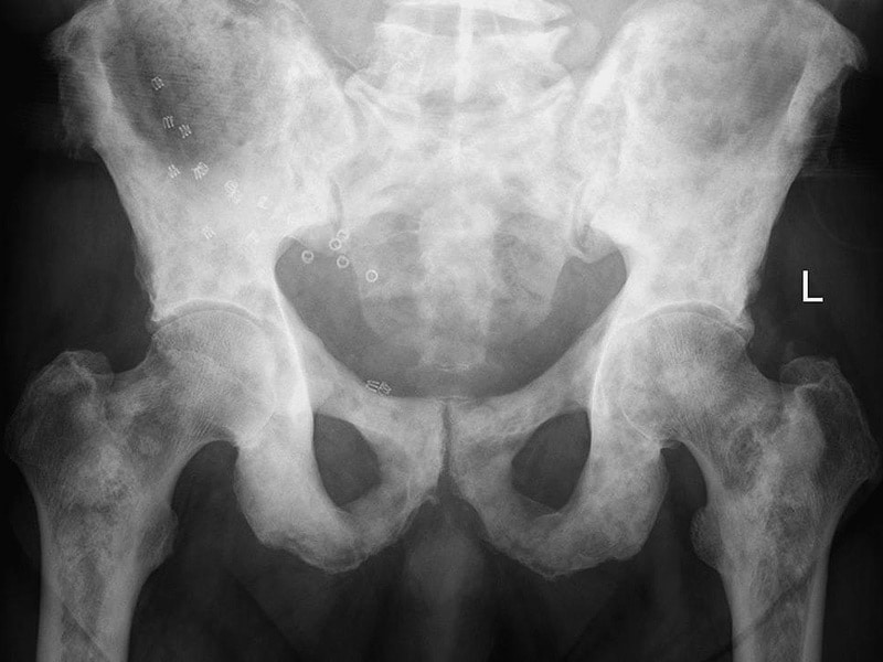 prostate carcinoma metastasis radiology