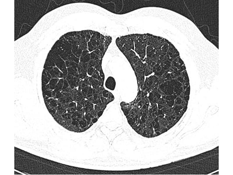 a-new-definition-for-emphysema