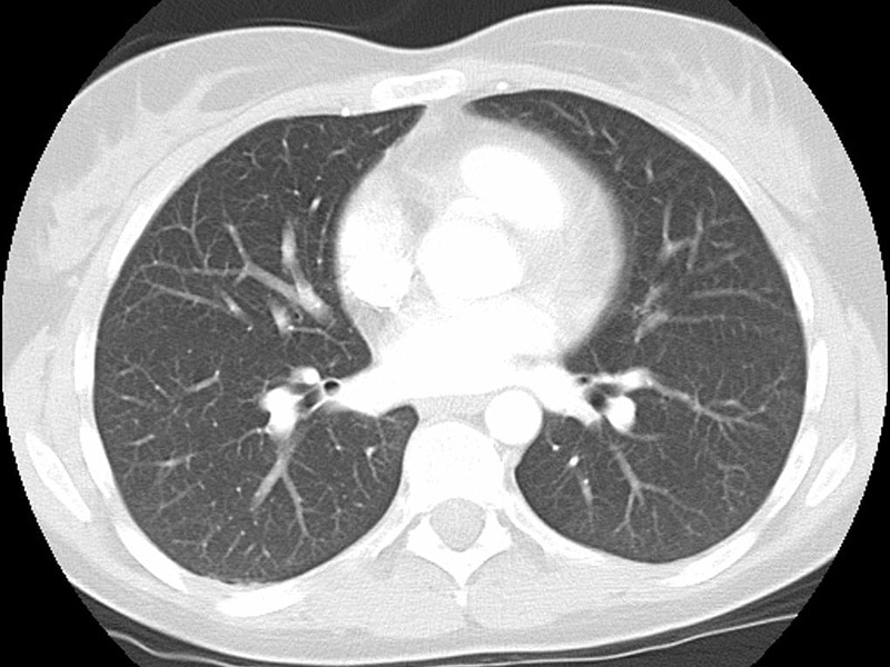 Shared Decision 'Virtually Absent' in Lung Cancer Screen Chat