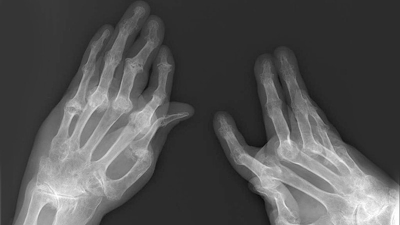 Studie validiert neues Tool zur Vorhersage von Psoriasis-Arthritis