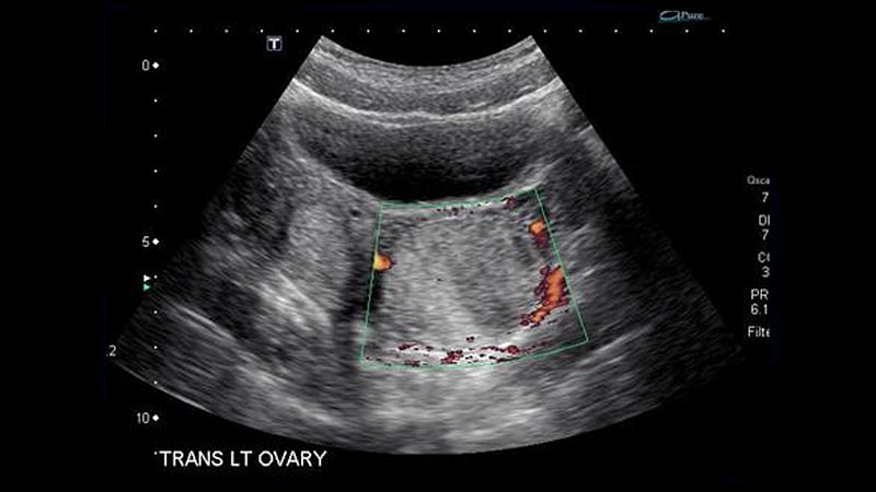 simple ovarian cyst ultrasound