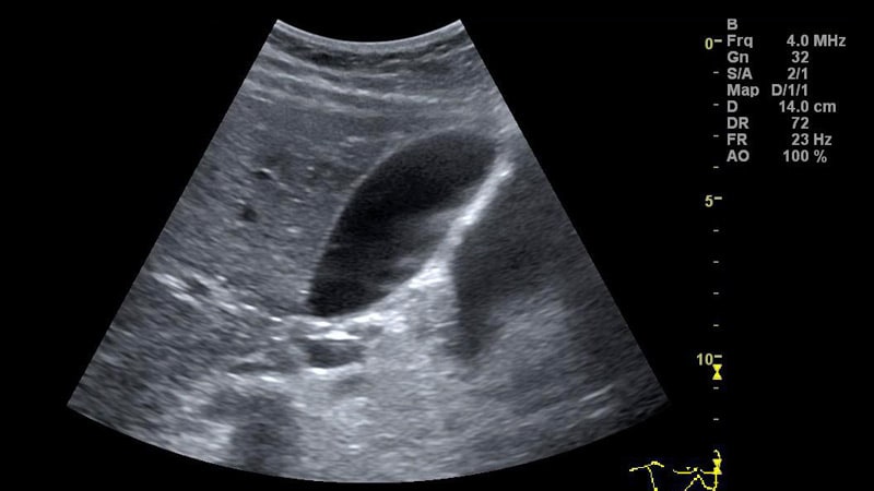 What Do Ovarian Cysts Look Like On Ultrasound