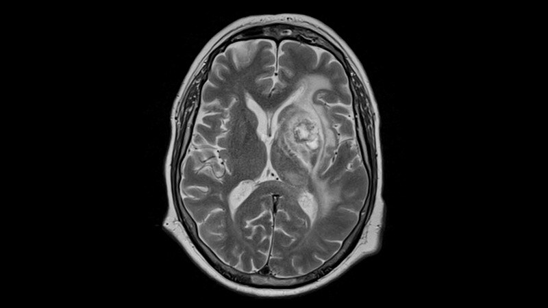 MRI Predicts Response to VEGF Inhibitor in Recurrent Glioblastoma thumbnail