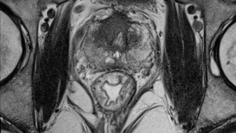 mri-reliably-identifies-significant-prostate-cancer