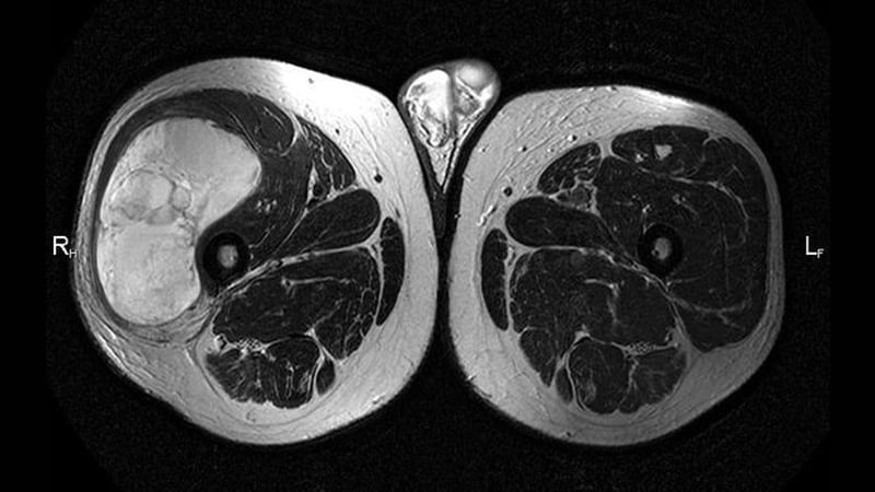 Liposarcoma Ultrasound