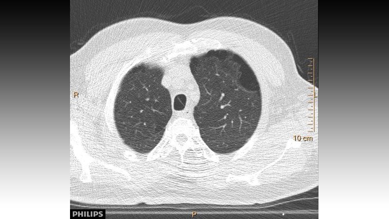 USPSTF Expands Criteria for Lung Cancer Screening