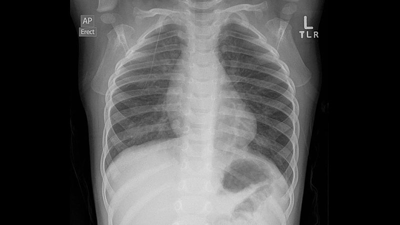 Infant Bronchiolitis Subtype May Predict Asthma Risk   Rp 220204 Viral Bronchiolitis 800x450 