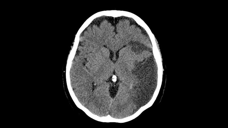La thrombectomie profite aux grands accidents vasculaires cérébraux après une simple imagerie