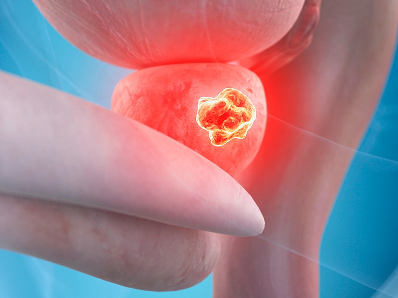 Metastasis Site Affects Prostate Cancer Survival