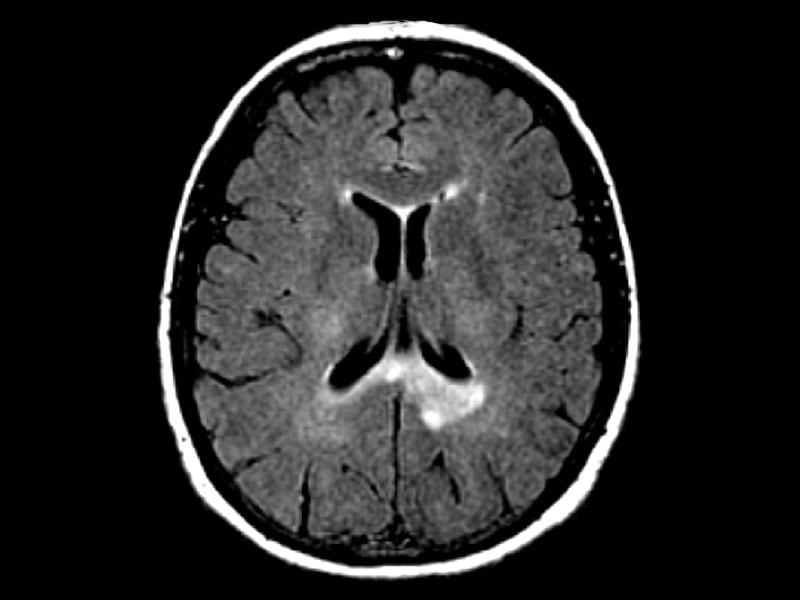 Brain Gadolinium Deposition Varies With Contrast Agent in MS